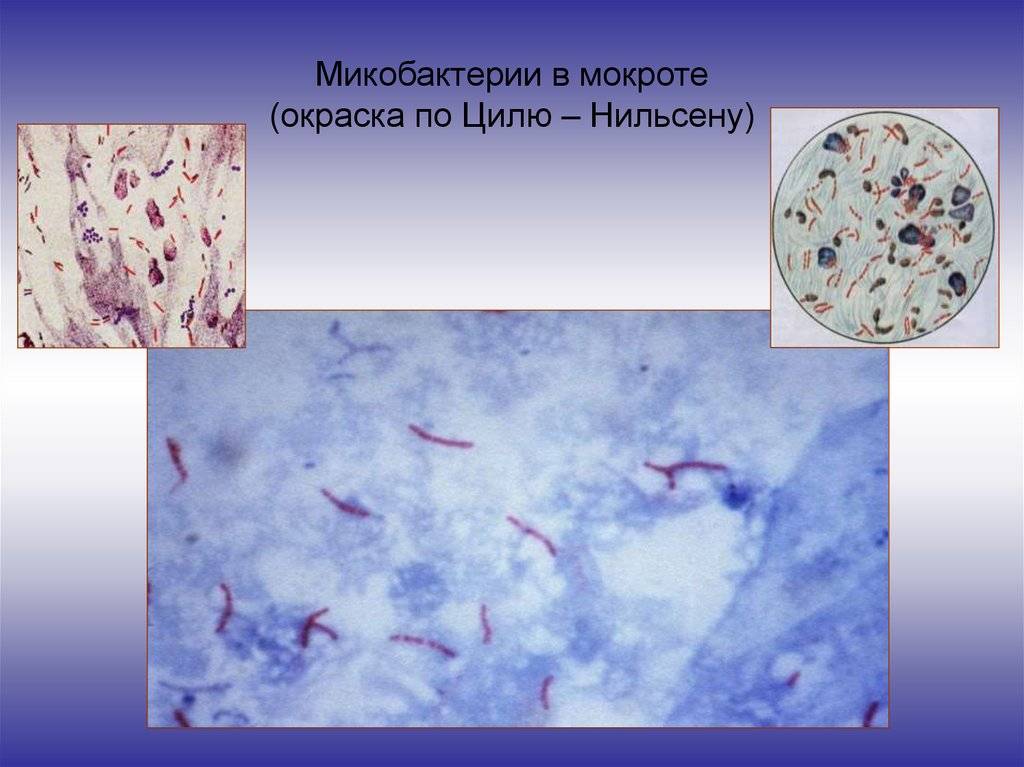 Альвеолярные макрофаги в мокроте: норма и отклонения, причины изменения количества, последствия