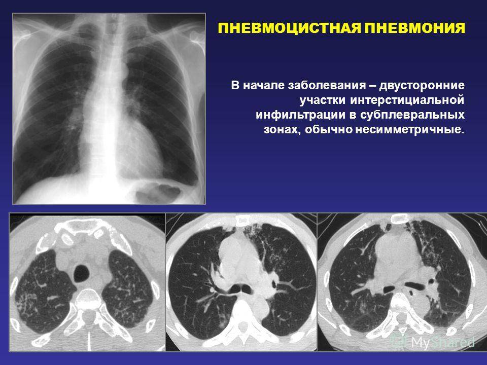 Двухсторонняя пневмония: причины, симптомы, лечение, последствия, смертность