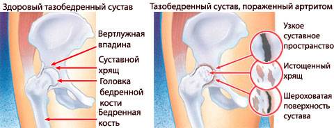 Артрит тазобедренного сустава: симптомы и лечение препаратами. ревматоидный, подагрический артрит бедренного сустава