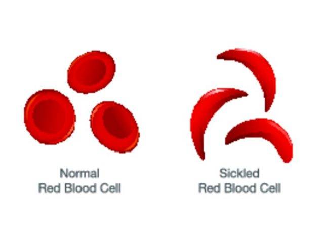 Как лечить серповидноклеточную (серповидную) анемию и ее симптомы