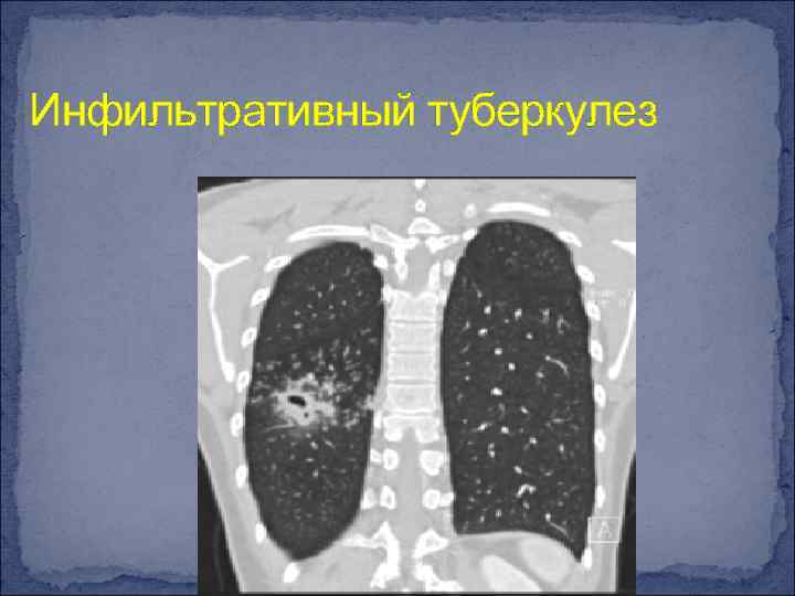 Инфильтративный туберкулез легкого: что это такое, заразен или нет? лечение базовое и народными средствами, дифференциальная диагностика