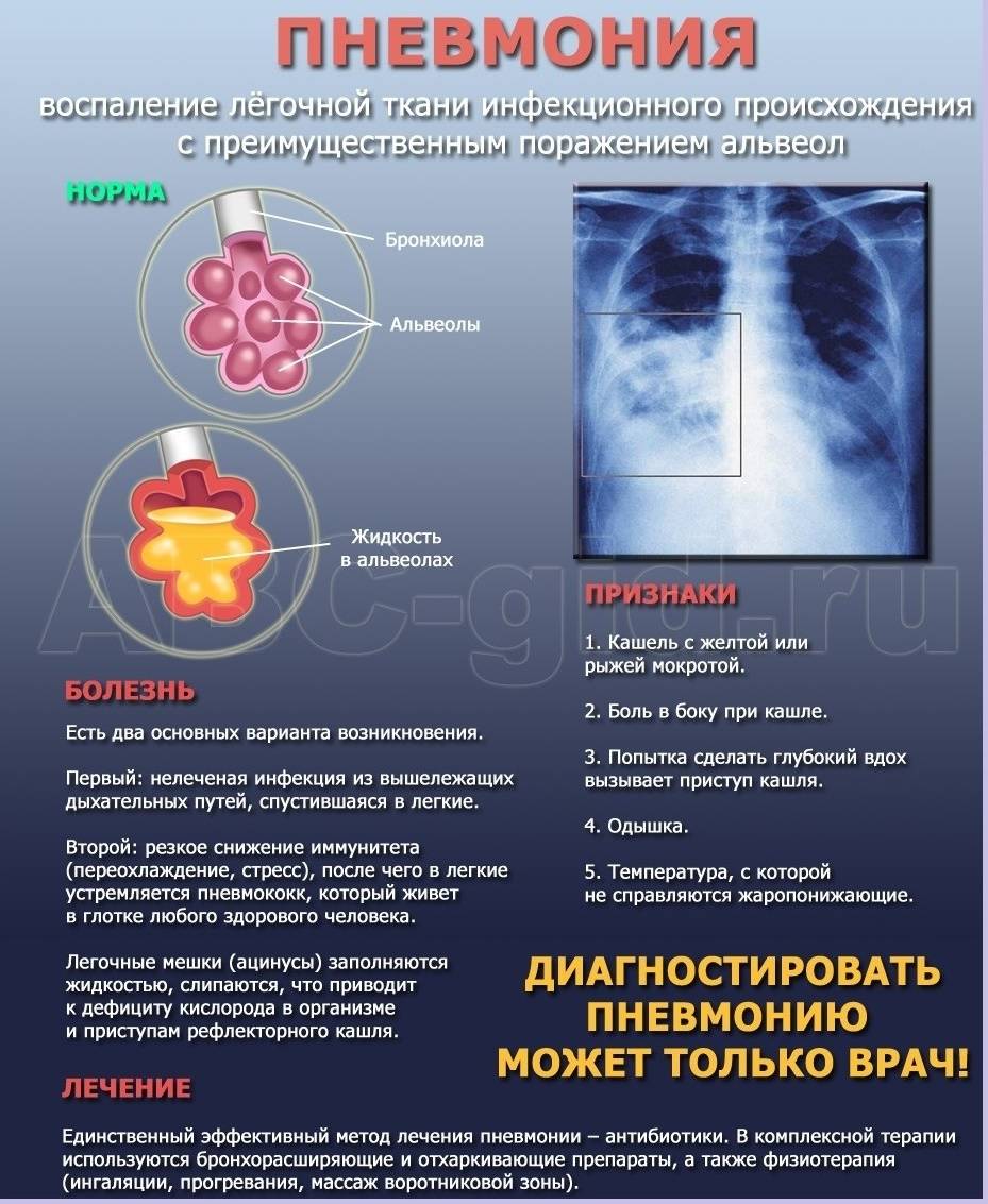 Инфекционная пневмония: симптомы и признаки воспаления легких