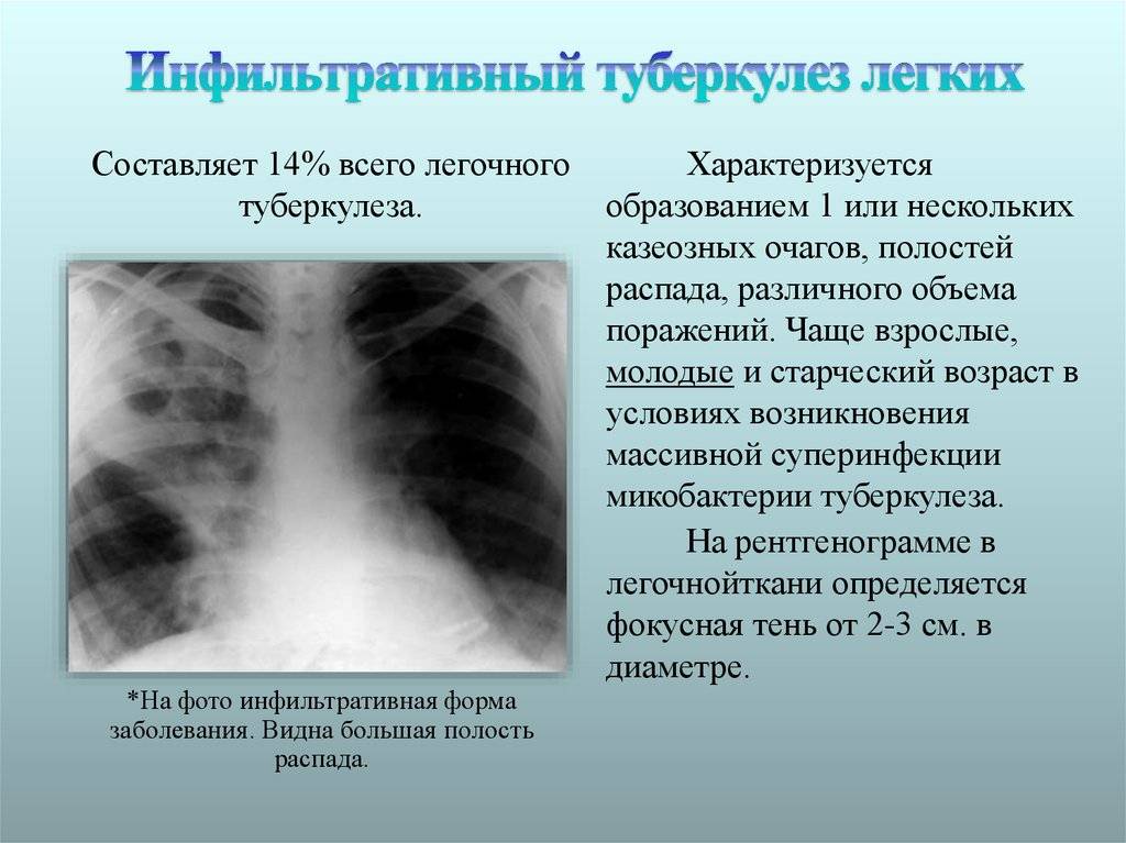 Инфильтративный туберкулез: причины, симптомы, лечение, прогноз