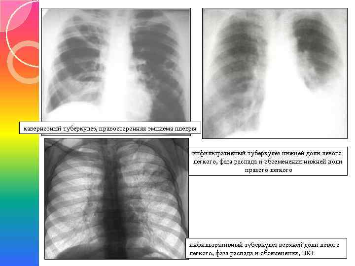 Инфильтративный туберкулез легких заразен или нет?