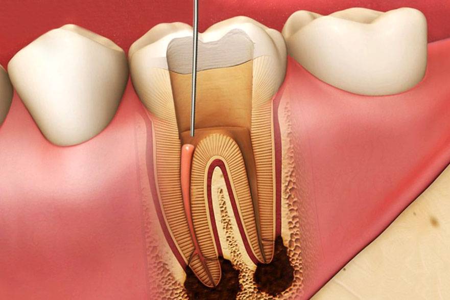 Депульпирование зуба перед протезированием – зачем и как проводится процедура