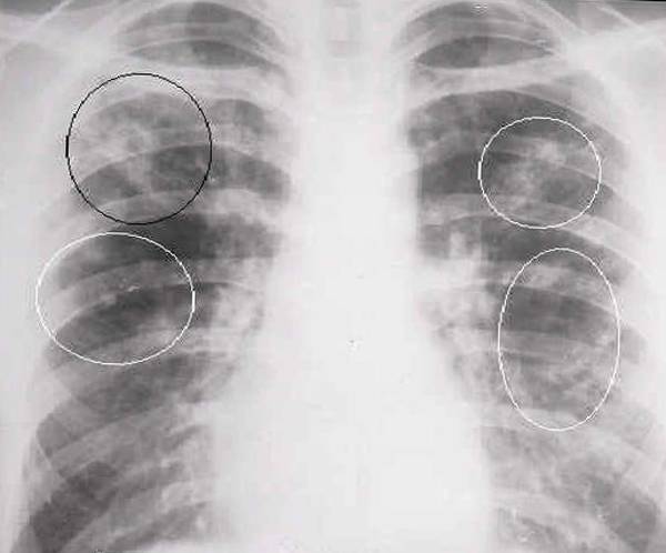 Классификация туберкулеза легких, коды по мкб -10