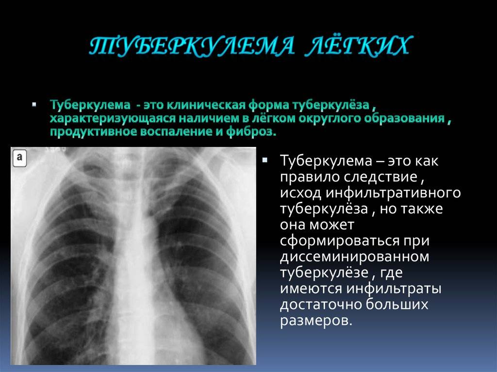 Туберкулез легких: симптомы у взрослых, лечение, фото