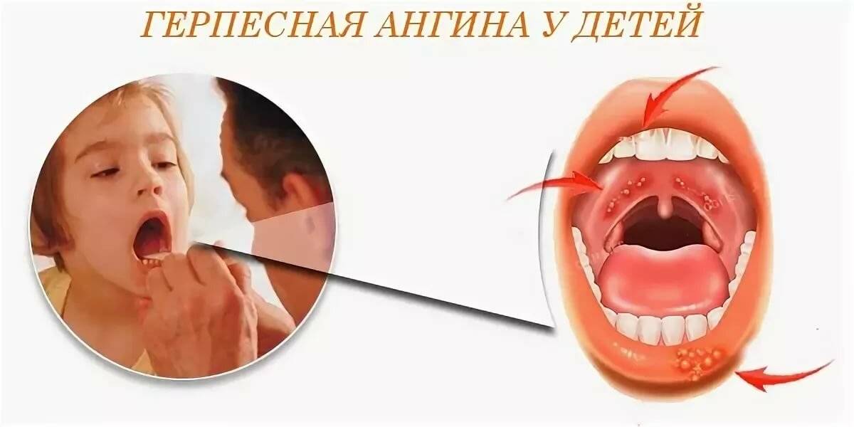 Герпесная ангина: симптомы и лечение, осложнения, инкубационный период