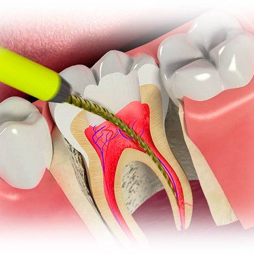 Депульпирование зуба перед протезированием: что это такое, нужно ли депульпировать под коронку