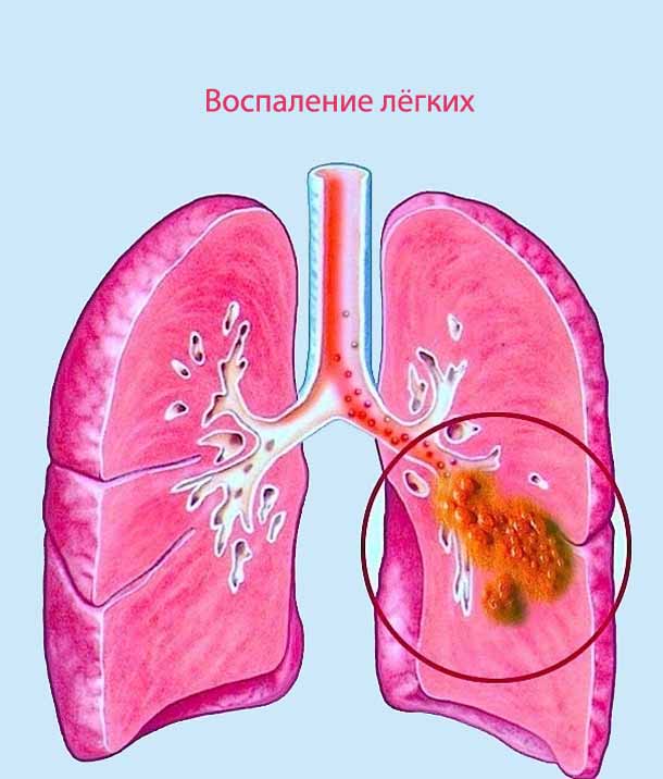 Что такое пневмония и чем она опасна для здоровья детей, взрослых и окружающих