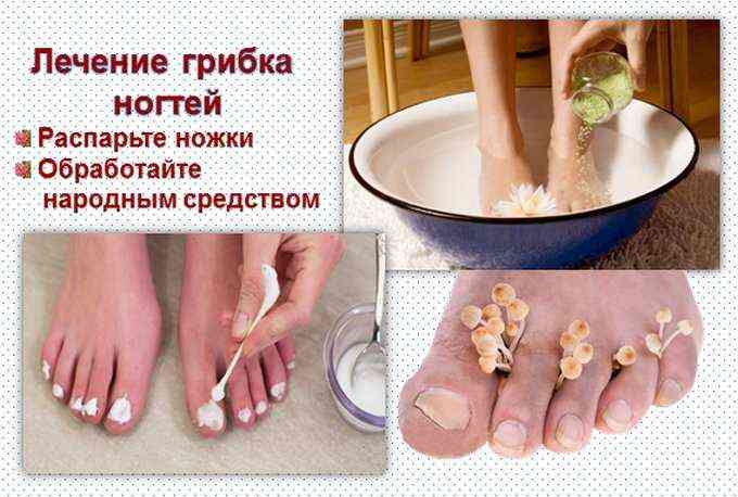Как избавиться от грибка на ногтях ног быстро народными средствами