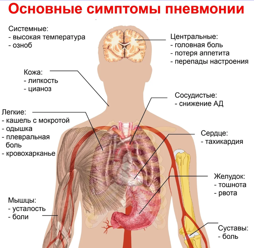 Пневмония – симптомы инфекционного воспаления легких