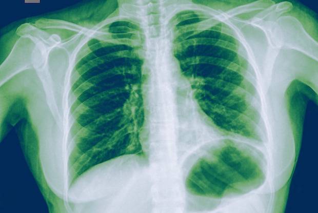 Пневмония - симптомы воспаления легких у взрослого человека, первые признаки без температуры, как проявляется, причины, как определить
