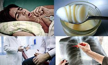 Лечение туберкулеза народными средствами в домашних условиях - применение барсучьего жира для легких