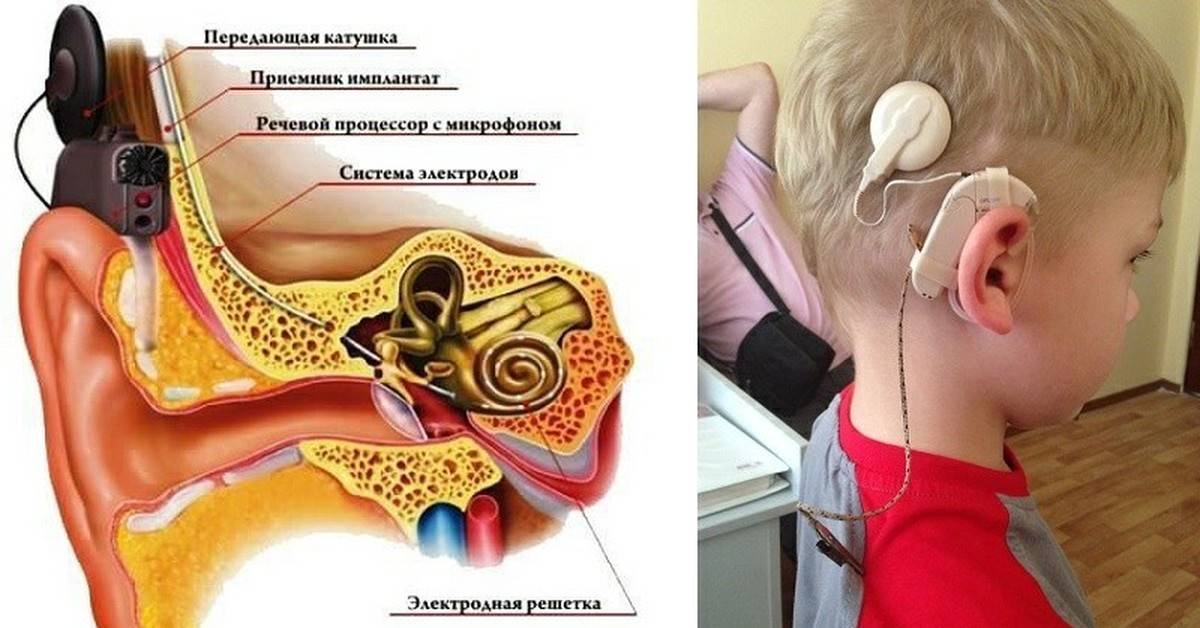 Сенсоневральная тугоухость 2 степени. восстановить слух при тугоухости.
