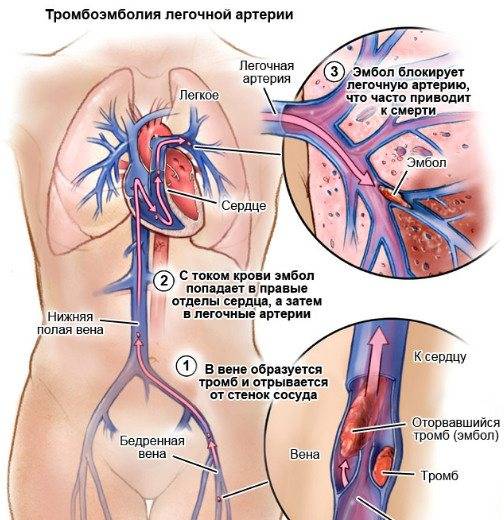 Тромбоэмболия легочной артерии. новые рекомендации esc.
