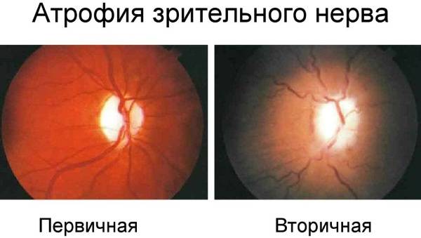 Атрофия зрительного нерва: частичная и полная