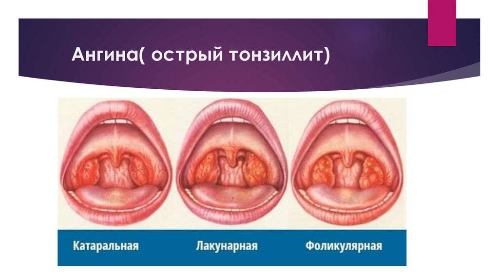 Тонзиллит у детей: симптомы и лечение (56 фото): как лечить острую и хроническую форму в горле в домашних условиях, профилактика