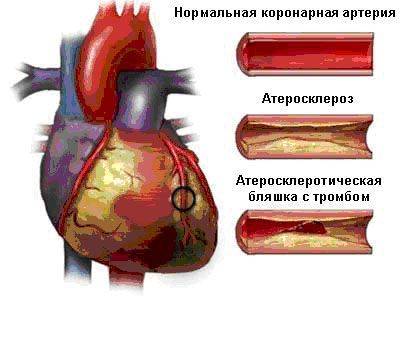 Атеросклеротический кардиосклероз: что это такое, симптомы и лечение