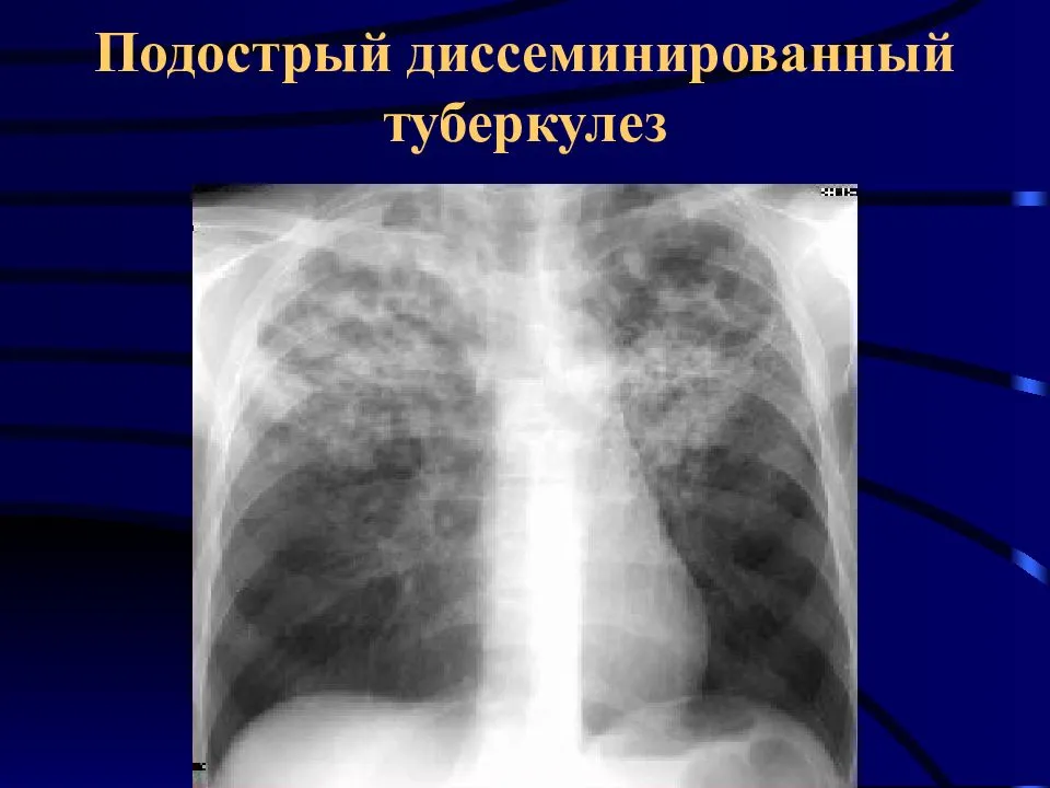 Выявление инфильтративного туберкулеза верхней доли правого легкого: симптомы, лечение, прогноз — стоптубик