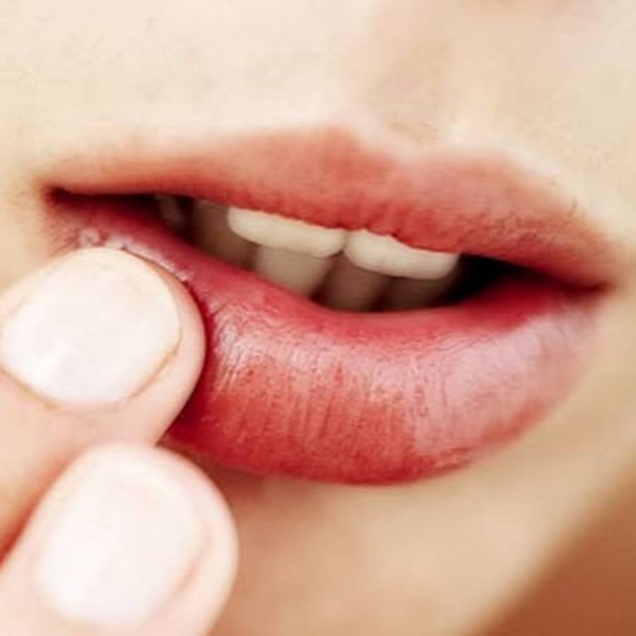 Как лечить хейлит на губах: самые эффективные препараты и народные методы