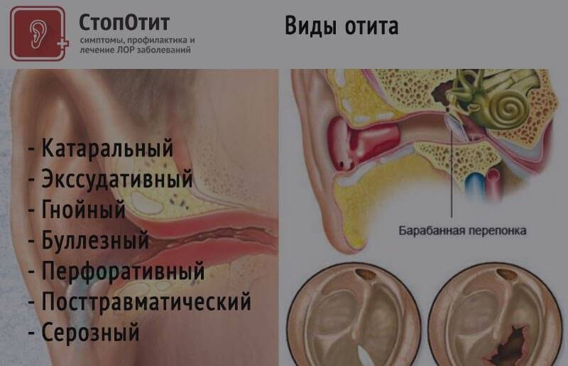 Воспаление среднего уха: симптомы и способы лечения