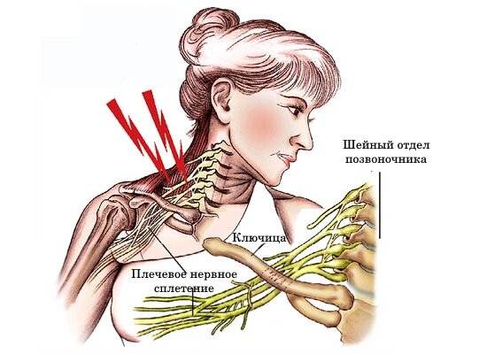 Невралгия плечевого нерва (сплетения, сустава) руки: симптомы и лечение