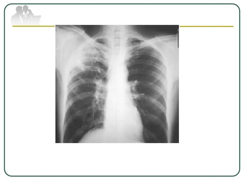 Туберкулез лёгких код мкб 10 - лечение