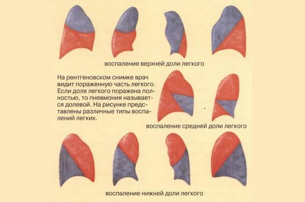 Признаки пневмонии на рентгеновском снимке