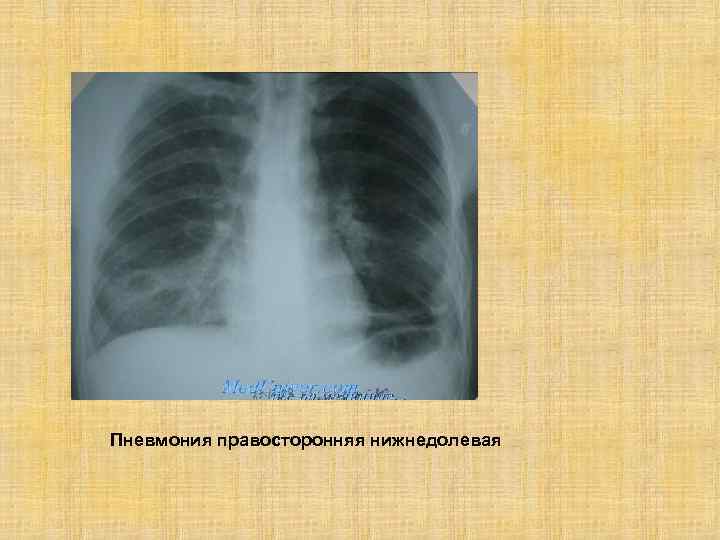 Левосторонняя пневмония – причины, симптомы, лечение