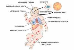 Причины и признаки внутриутробного инфицирования плода, последствия инфекции, анализ на вуи во время беременности