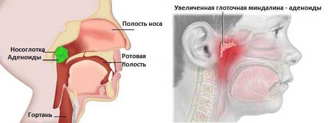 Жидкость в ушах у ребенка при аденоидах лечение - wc-master.ru