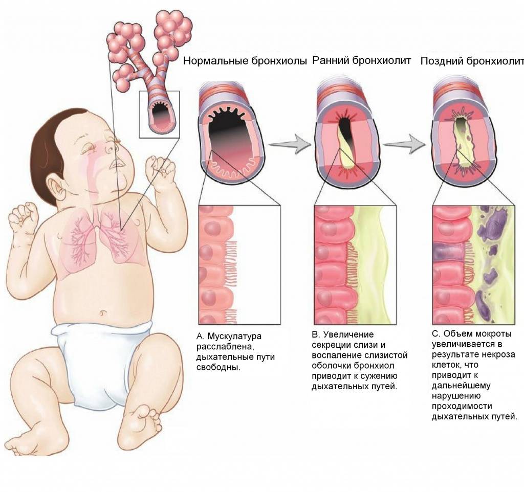 Первые признаки пневмонии у детей: симптомы и лечение, воспаление легких у детей до года, 2, 3 лет, грудничков