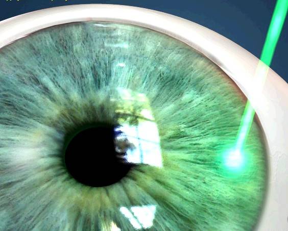 Кому проводится лазерная дисцизия вторичной катаракты?
