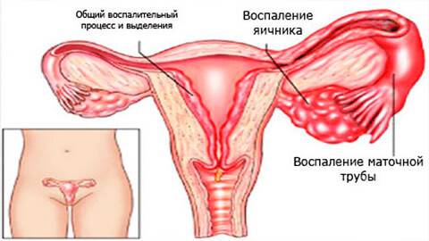 Воспаление яичников у женщин: симптомы и лечение