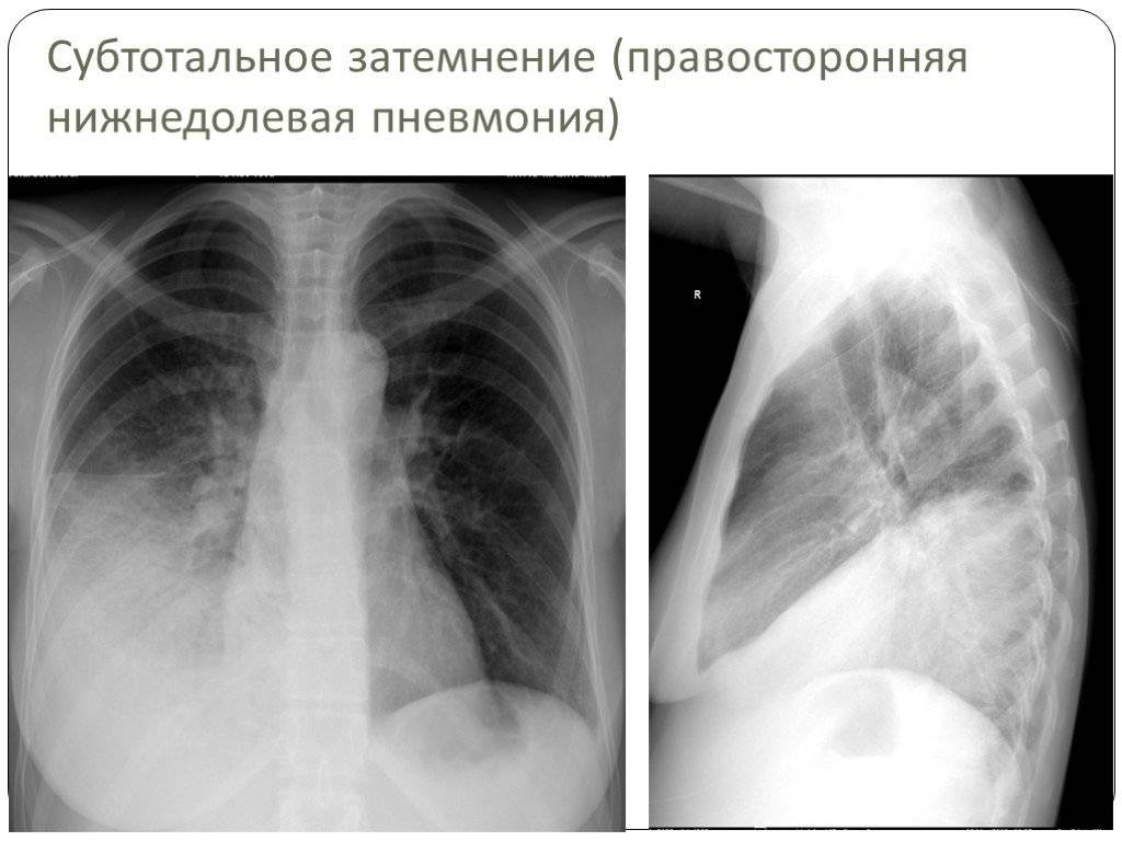 ✅ внебольничная нижнедолевая правосторонняя пневмония - vrach-med.ru