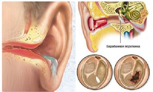 Наружный диффузный отит, основные симптомы и лечение диффузного отита наружного уха