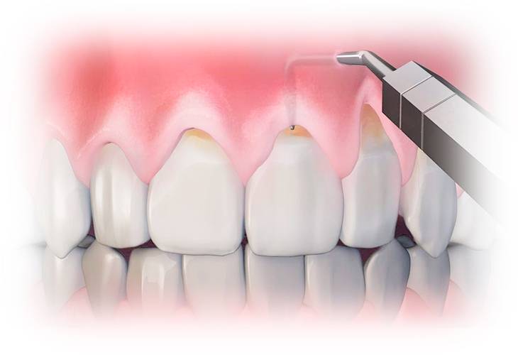 Методы лечения кариеса зубов: на передовой современной стоматологии