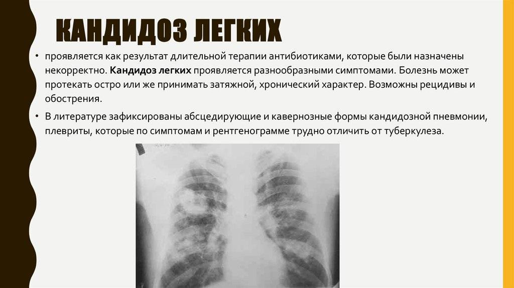 Как лечить грибок в лёгких