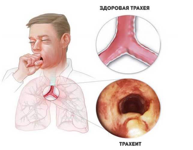 Воспаление трахеи - лечение если болит, как лечить фарингит и болезни гортани, верхних дыхательных путей глотки, хронический трахеит, ринофарингит