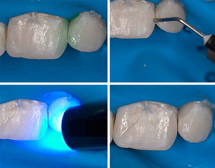 Лечение кариеса зубов в стоматологии – этапы, фото, стандарты терапии