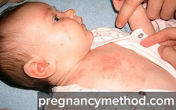 Туберкулез у новорожденных симптомы