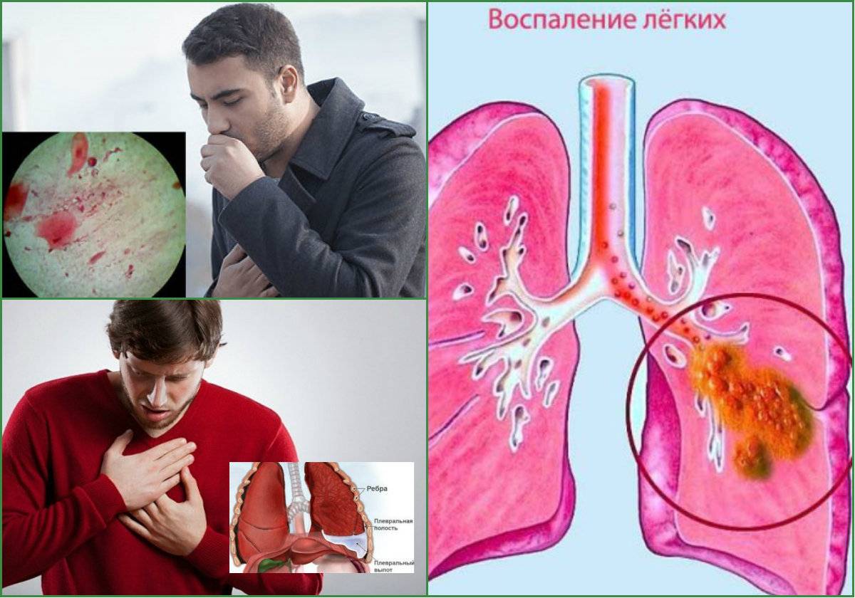 Пневмония — причины, симптомы и лечение пневмонии