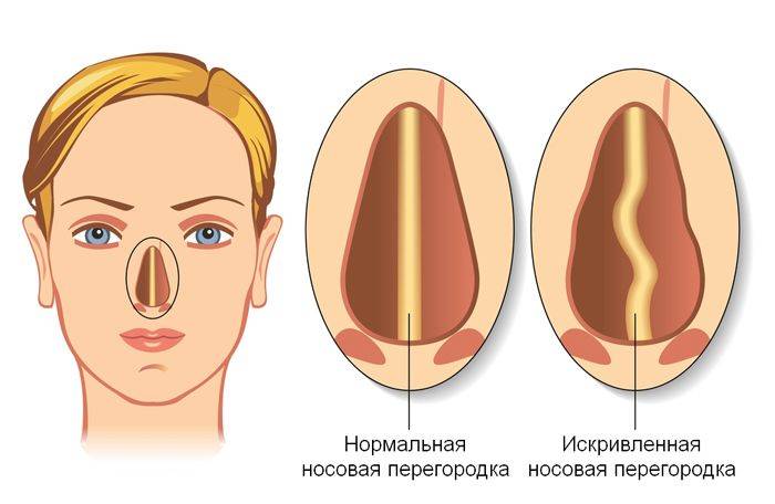 Гипертрофический ринит мкб-10: вазомоторная деформация носовой перегородки