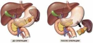 Липоматоз поджелудочной железы – прогноз, продолжительность жизни. диффузные изменения поджелудочной железы по типу липоматоза