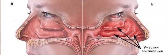 Хронический вазомоторный ринит: симптомы и лечение заболевания