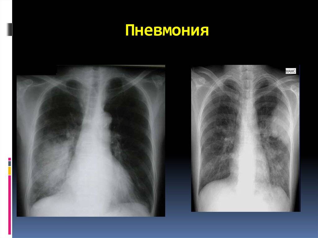 Первый признак воспаления легких у детей и взрослых: симтпомы пневмонии легкой формы, рентгенологические