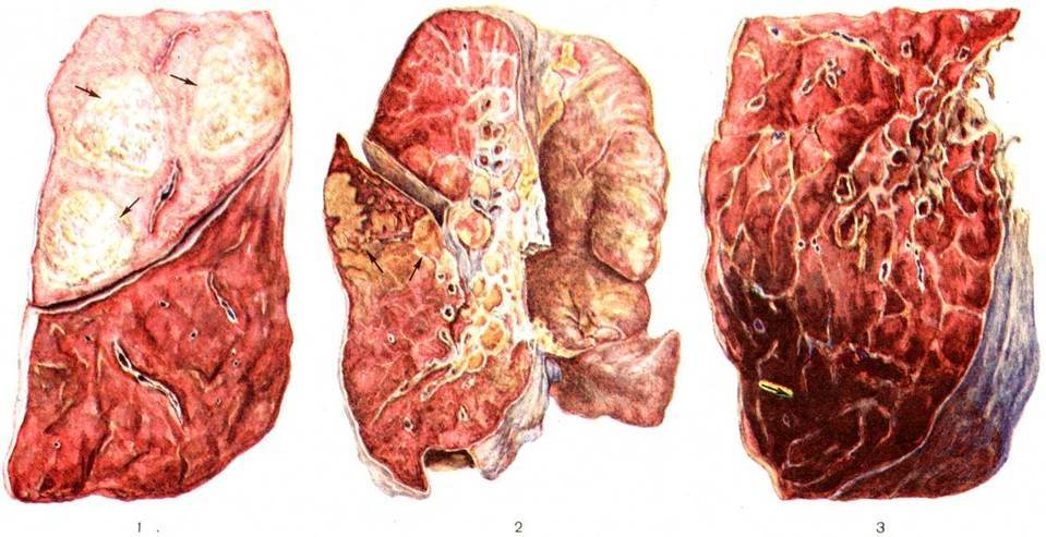 Воспаление легких у больных раком - про онкологию