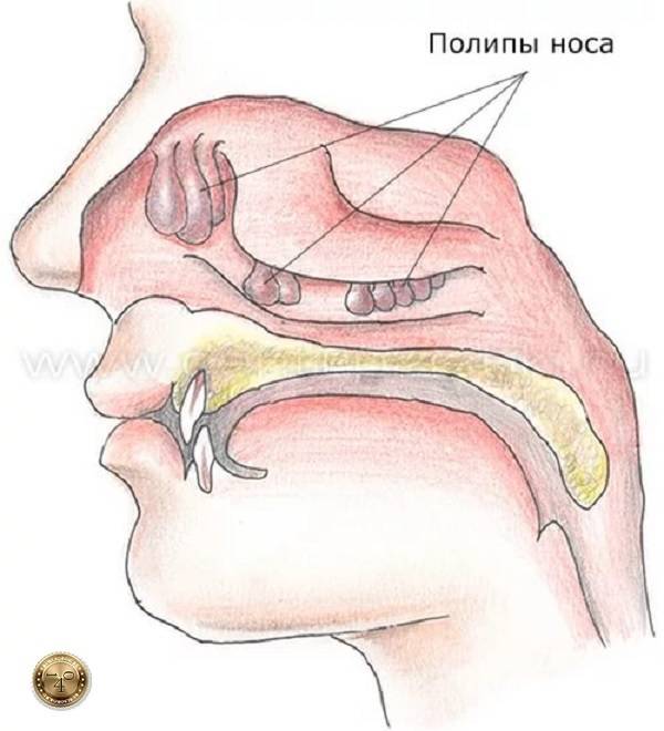 Полипы в носу у ребенка: причины, симптомы, стадии развития, консервативное и хирургические лечение