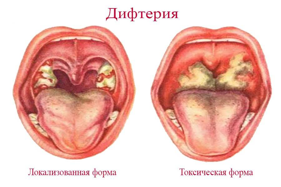 Герпесная ангина у детей: причины, инкубационный период, симптомы